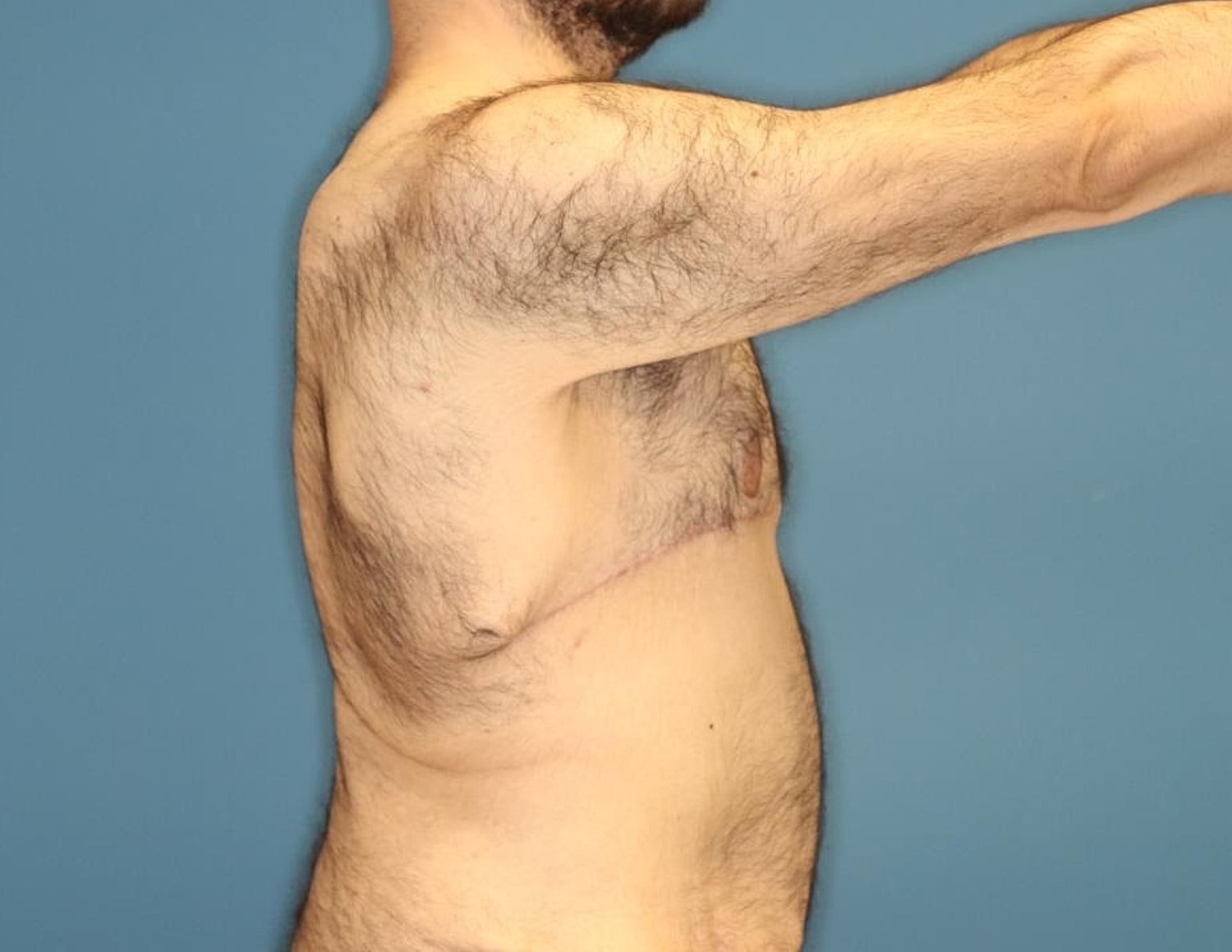 Gynecomastia Surgery Before & After