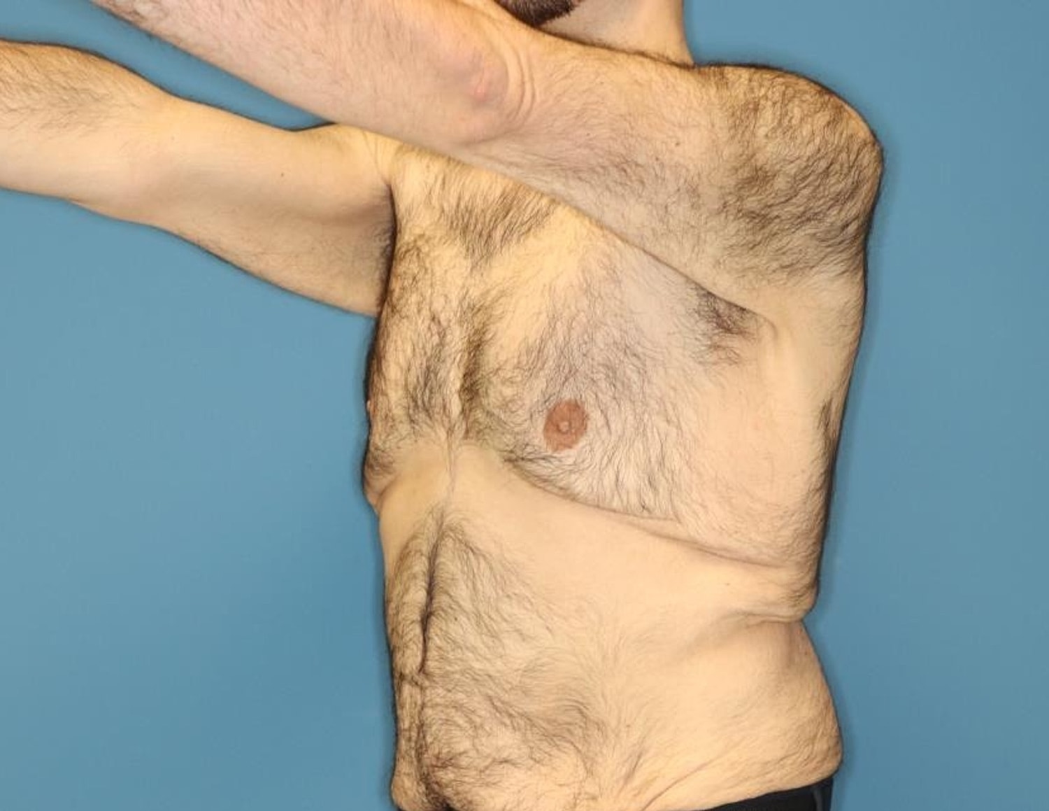 Gynecomastia Surgery Before & After
