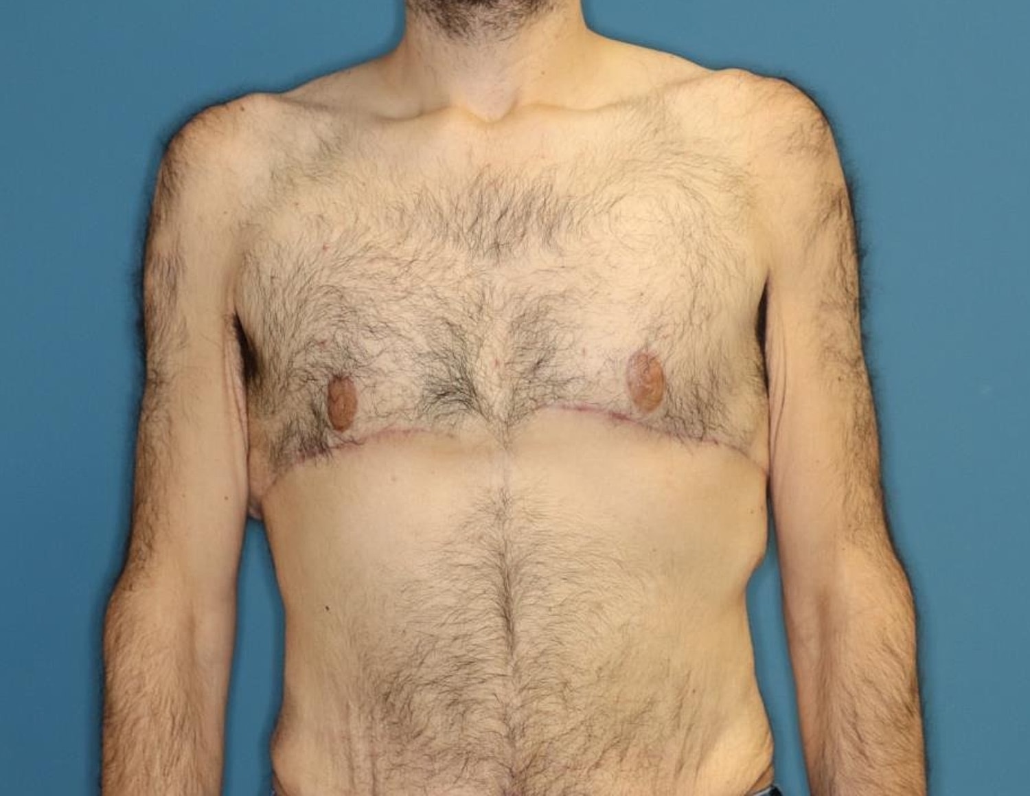 Gynecomastia Surgery Before & After