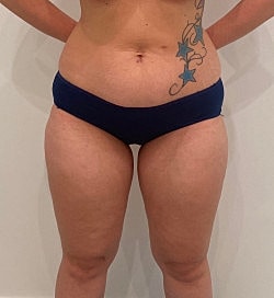 Abdominoplasty Before & After