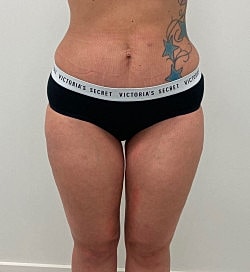 Abdominoplasty Before & After