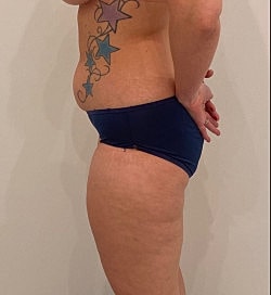 Abdominoplasty Before & After