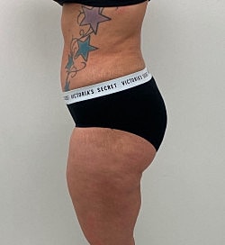 Abdominoplasty Before & After