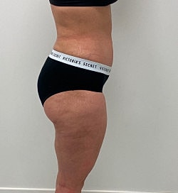 Abdominoplasty Before & After