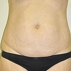 Abdominoplasty Before & After