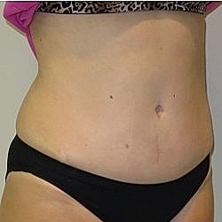 Abdominoplasty Before & After