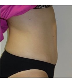 Abdominoplasty Before & After