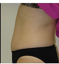 Abdominoplasty Before & After