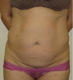 Abdominoplasty Before & After