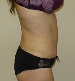 Abdominoplasty Before & After