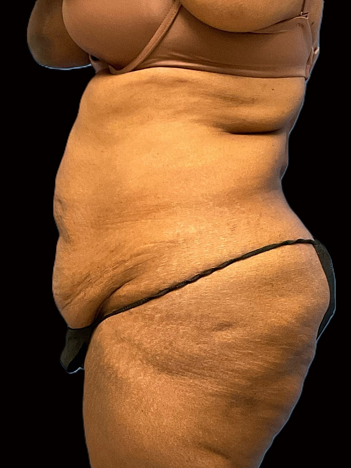 Tummy Tuck Before & After