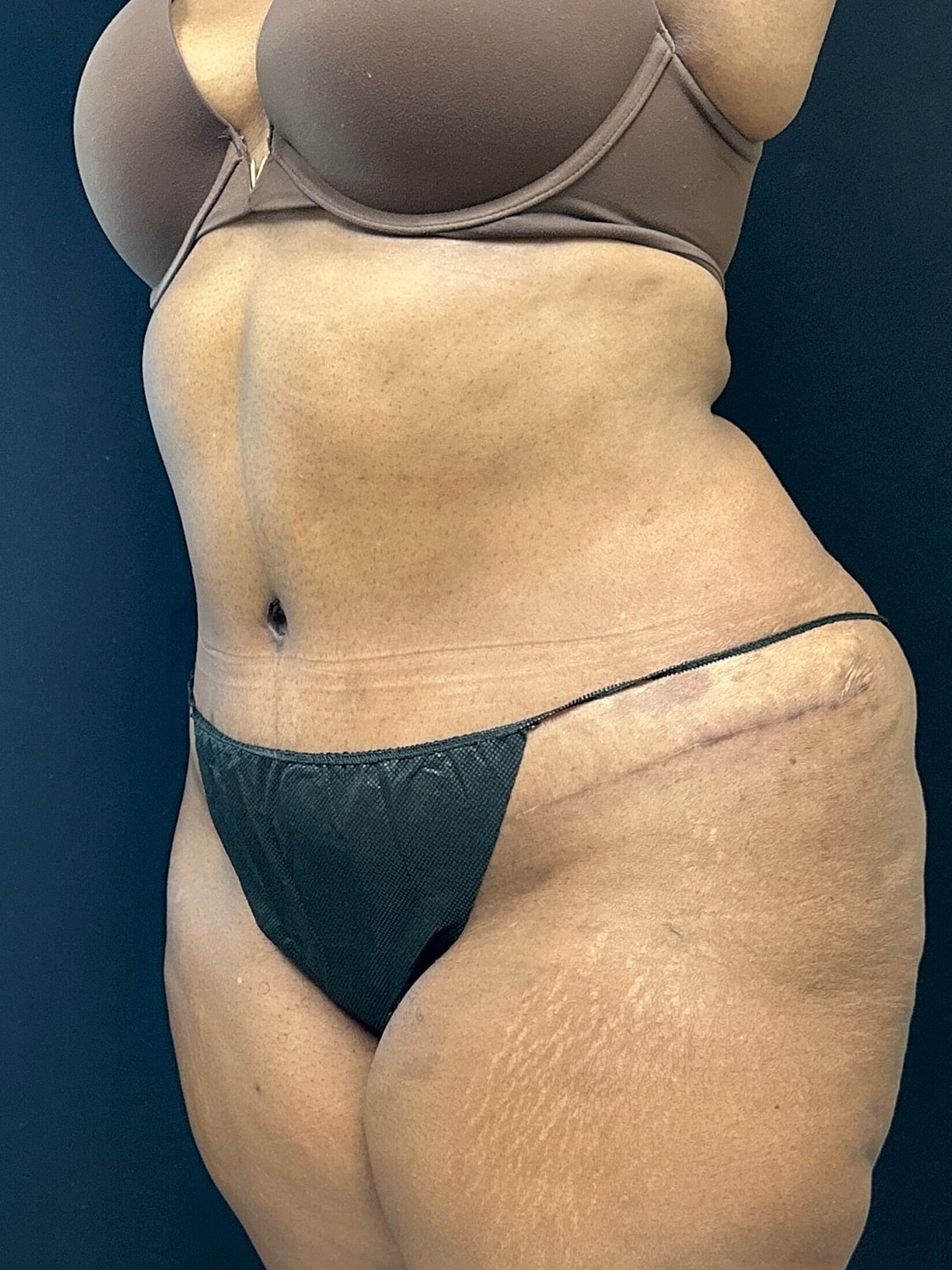 Tummy Tuck Before & After