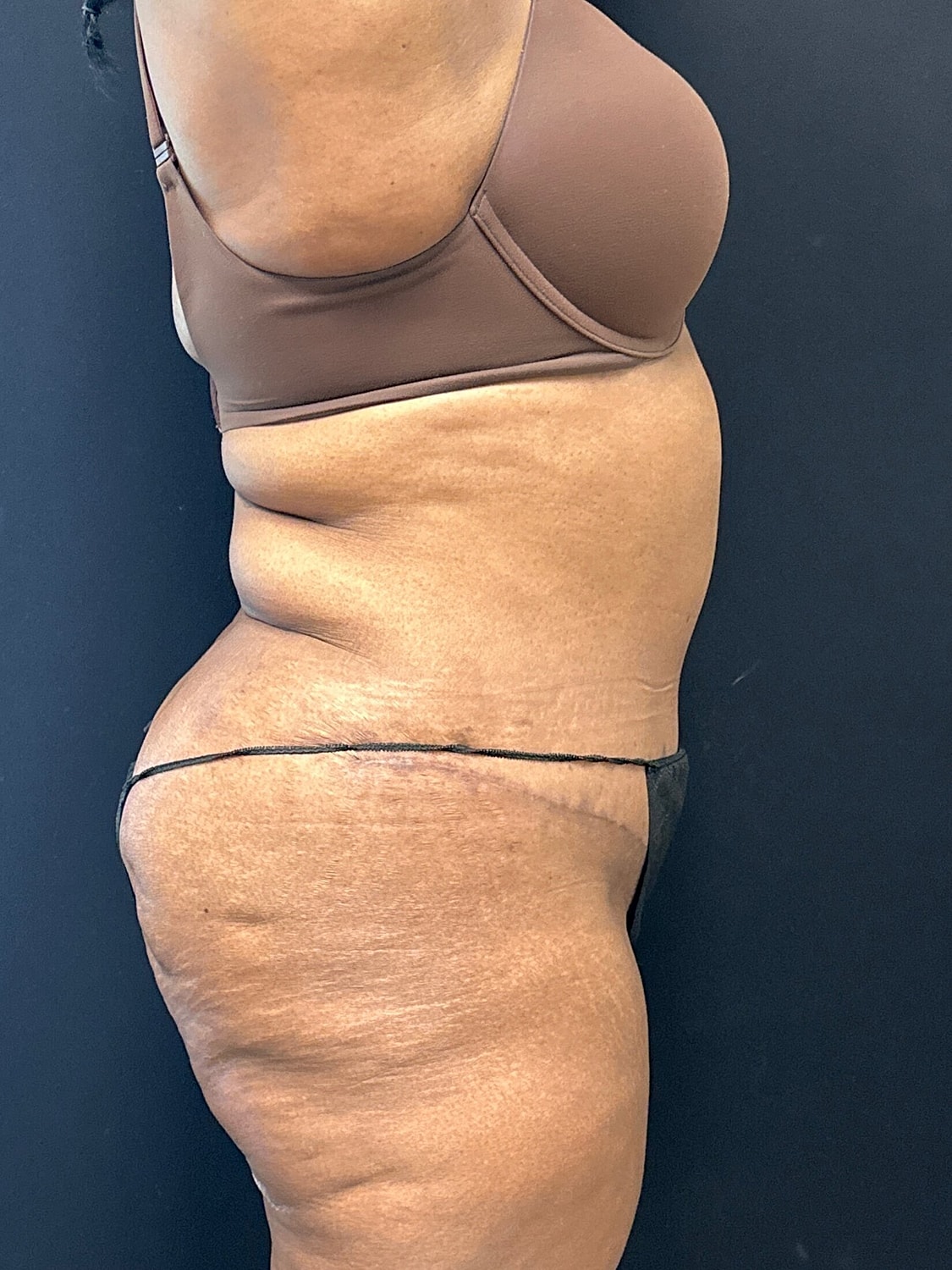 Tummy Tuck Before & After