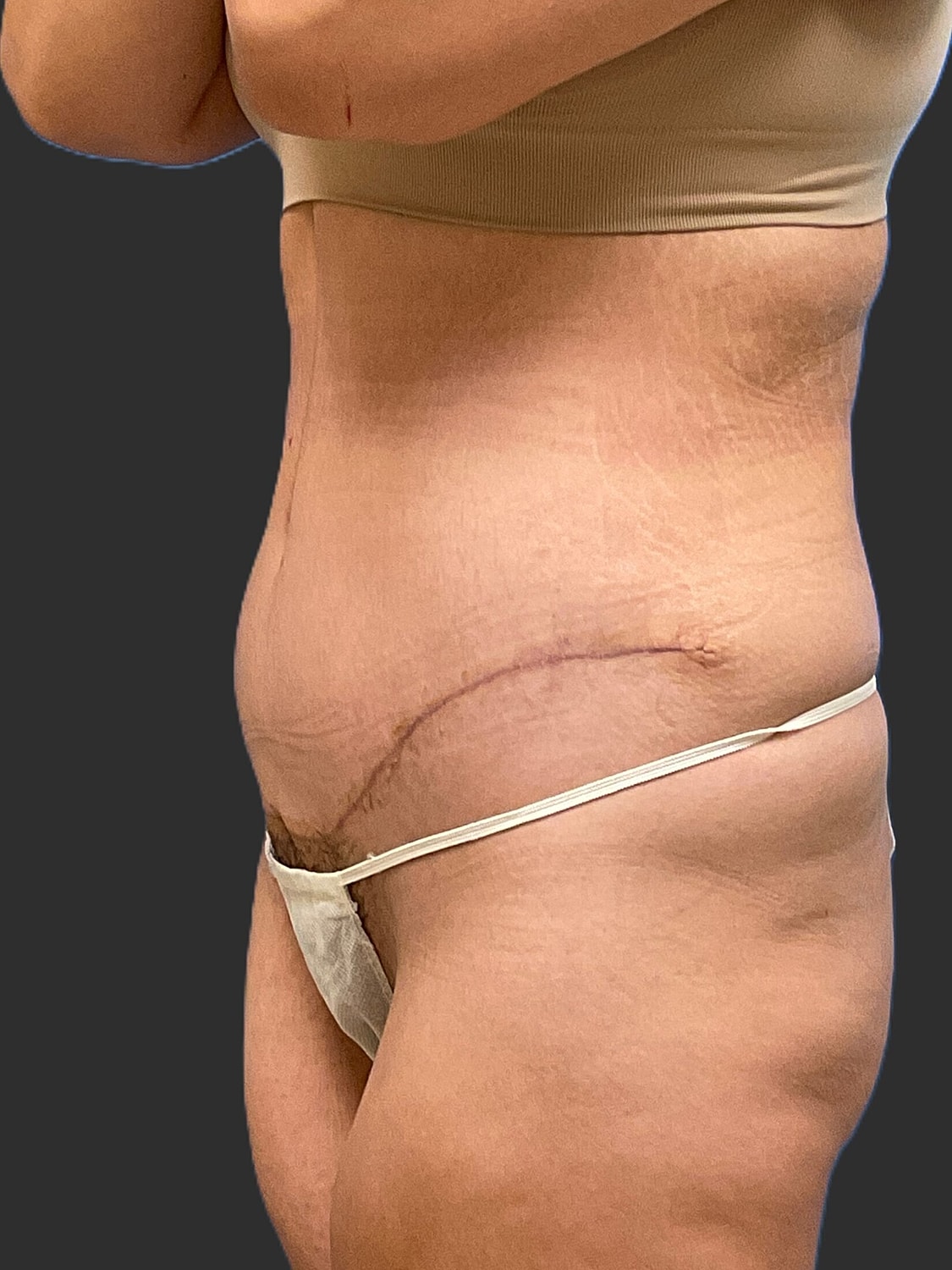 Tummy Tuck Before & After