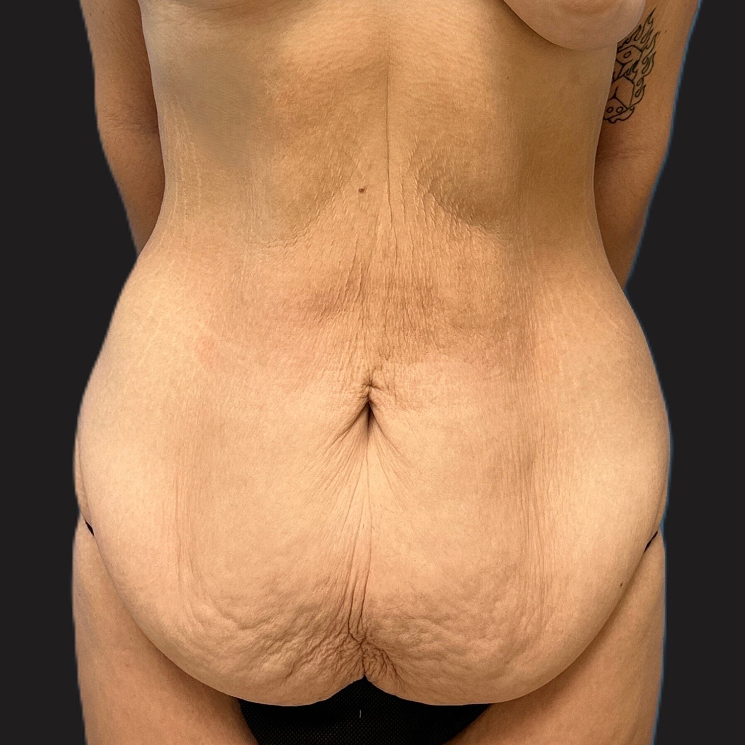 Tummy Tuck Before & After