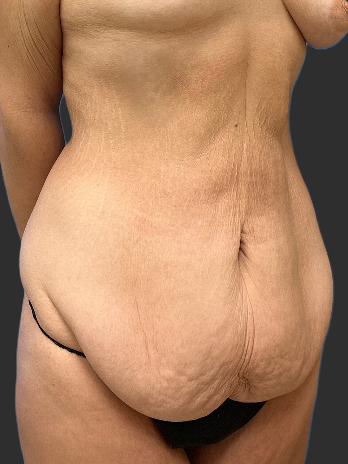 Tummy Tuck Before & After