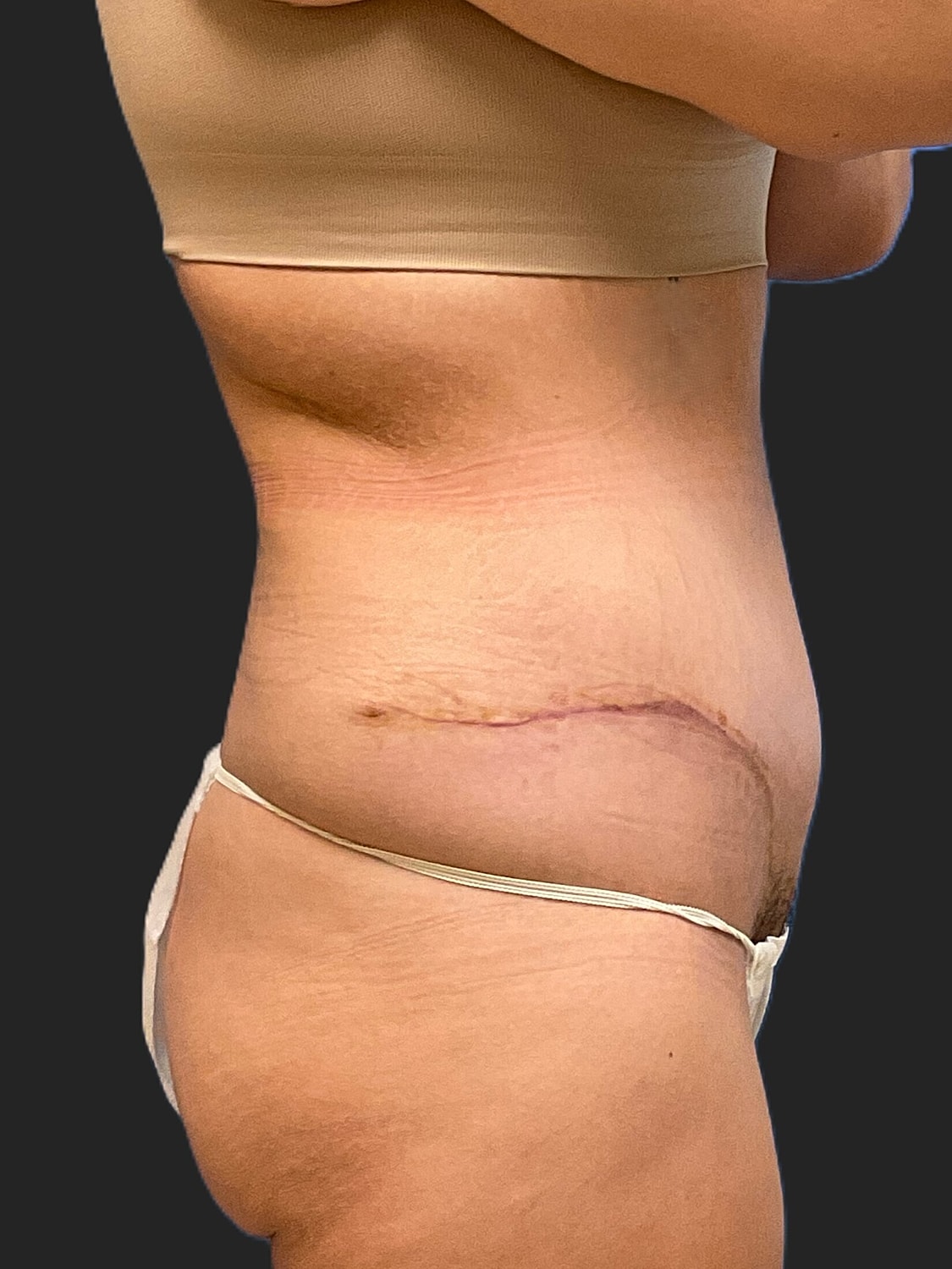 Tummy Tuck Before & After