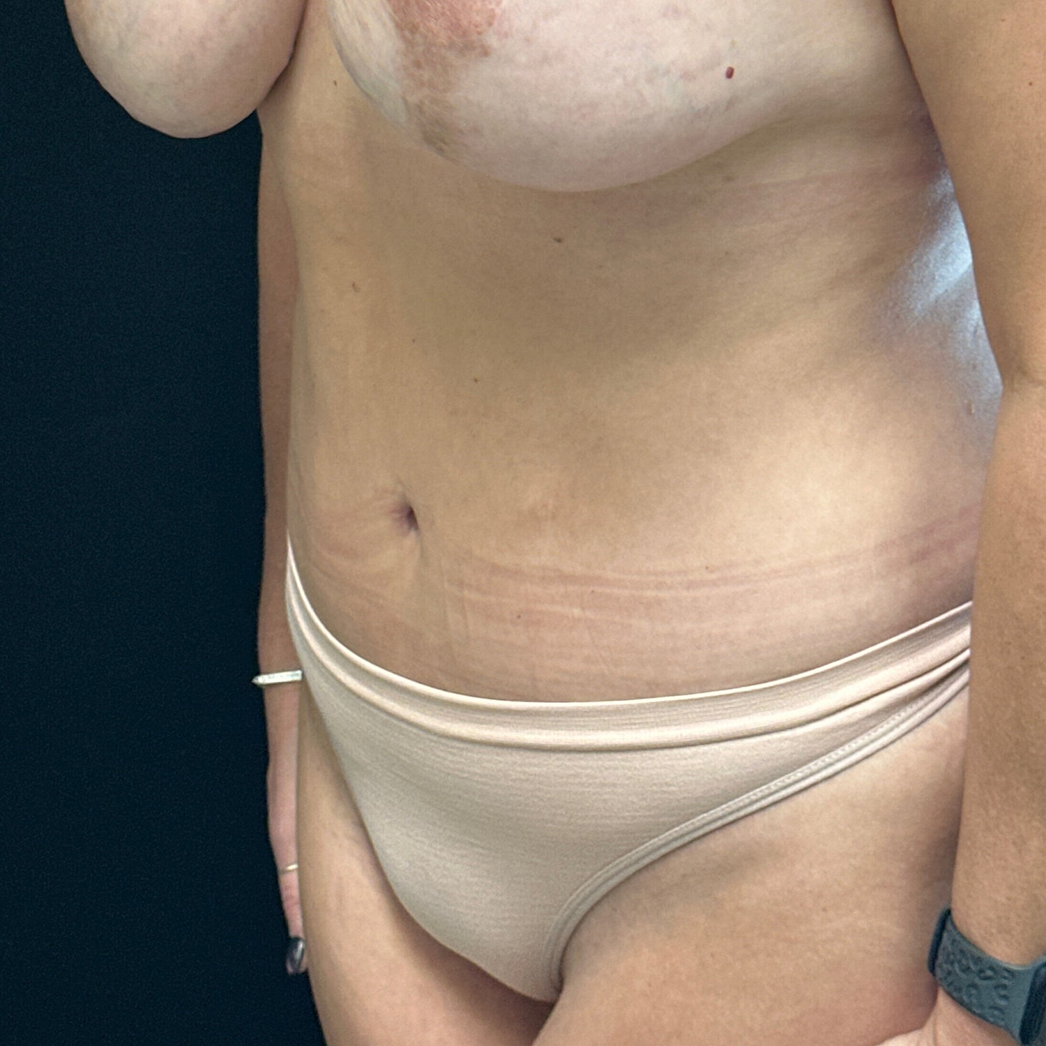 Tummy Tuck Before & After