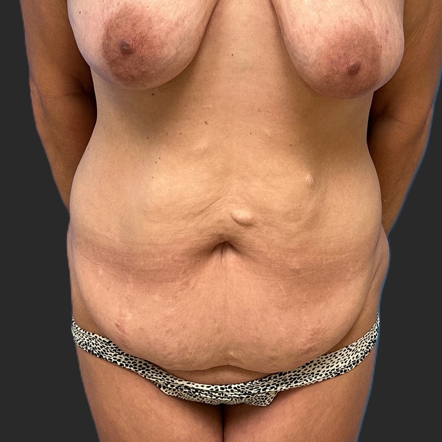 Tummy Tuck Before & After