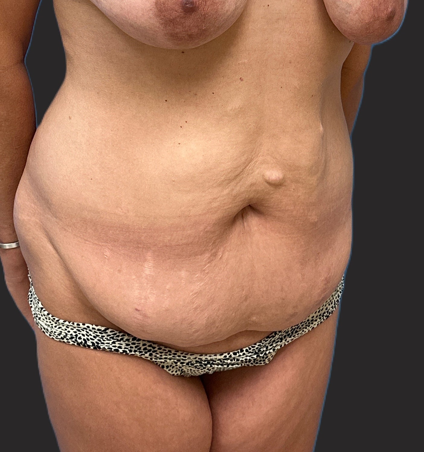 Tummy Tuck Before & After