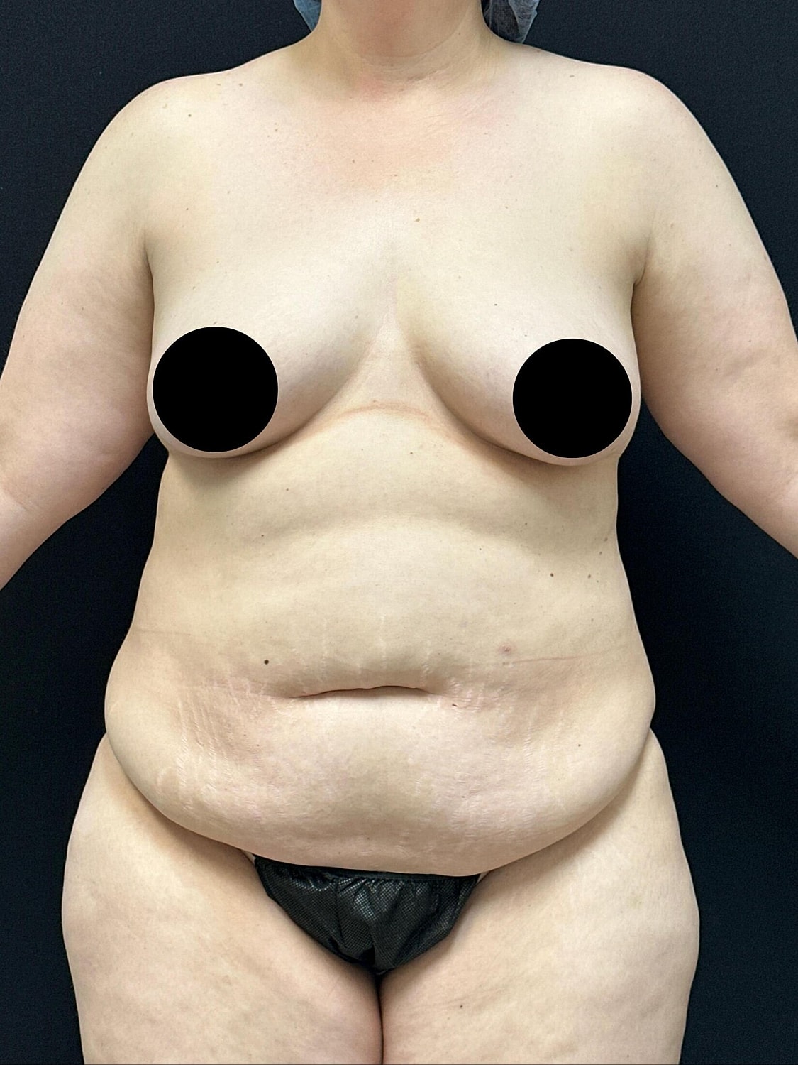 Tummy Tuck Before & After