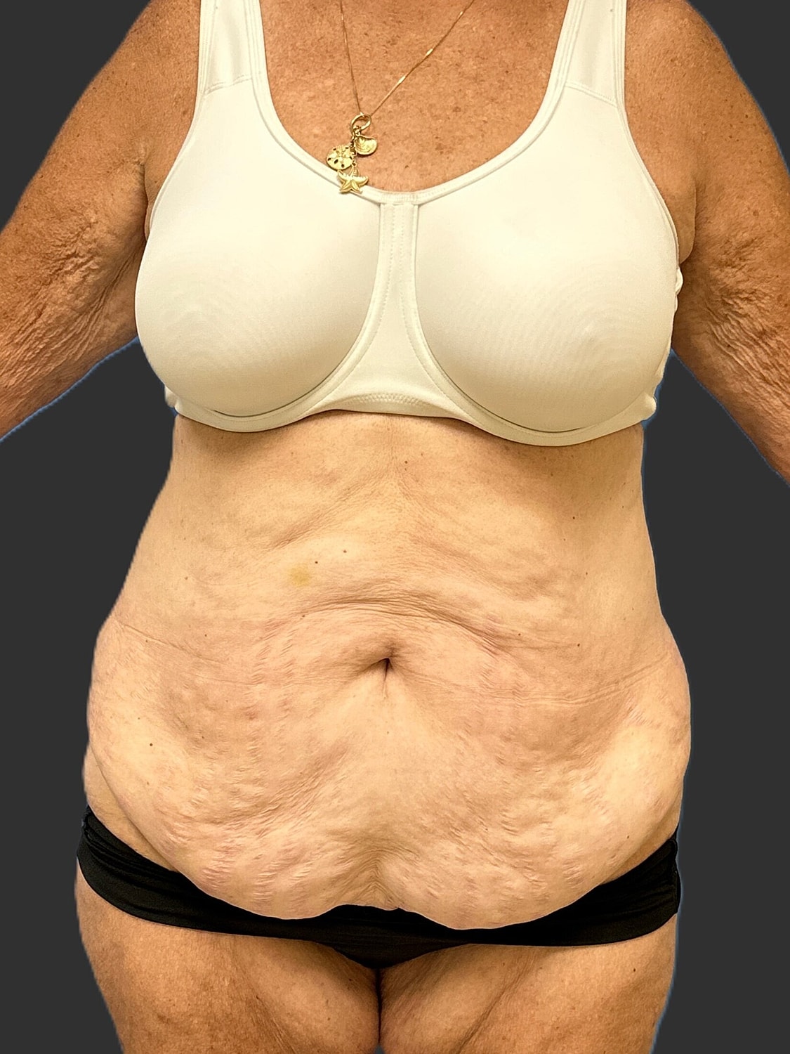 Tummy Tuck Before & After