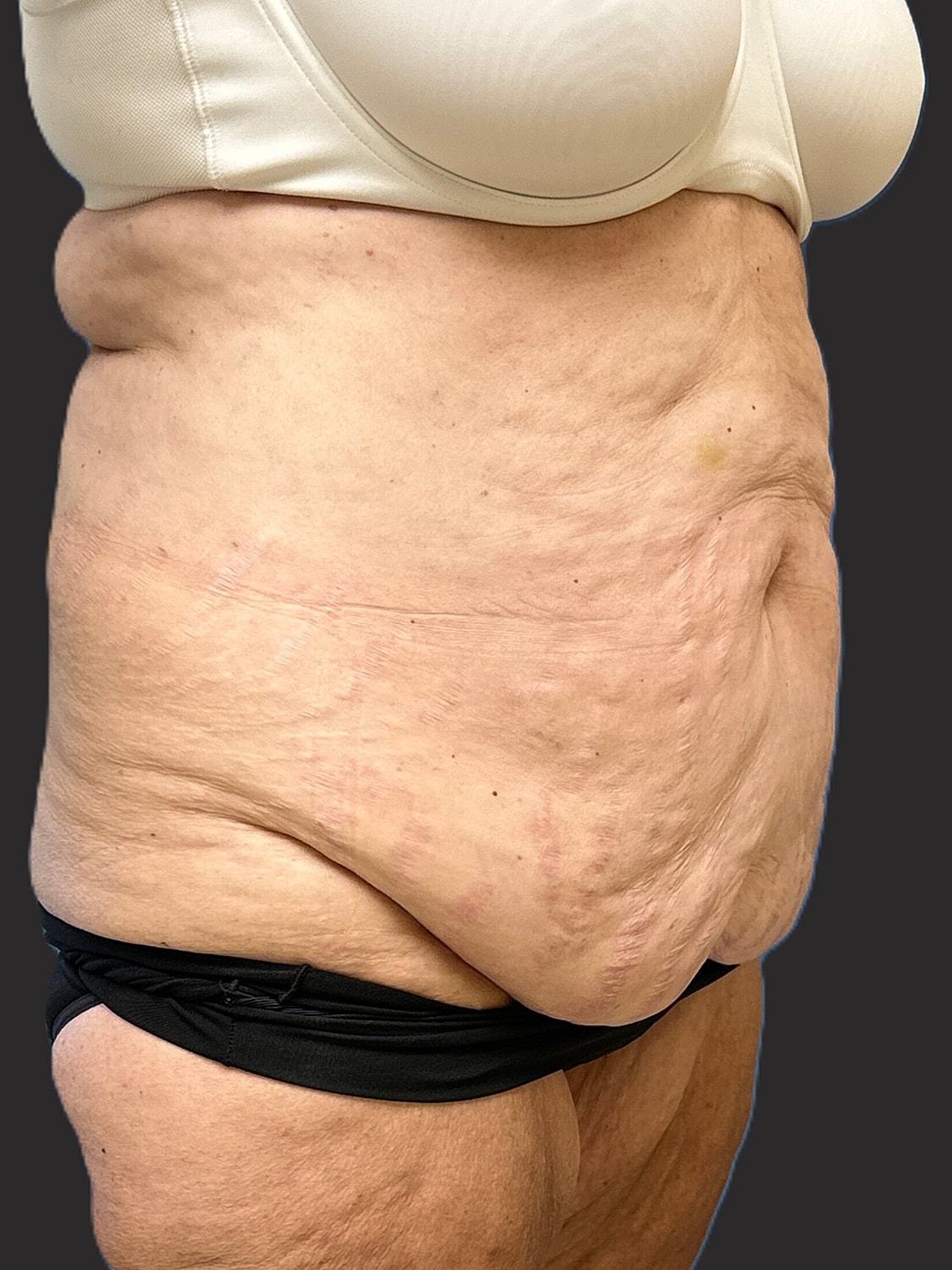 Tummy Tuck Before & After