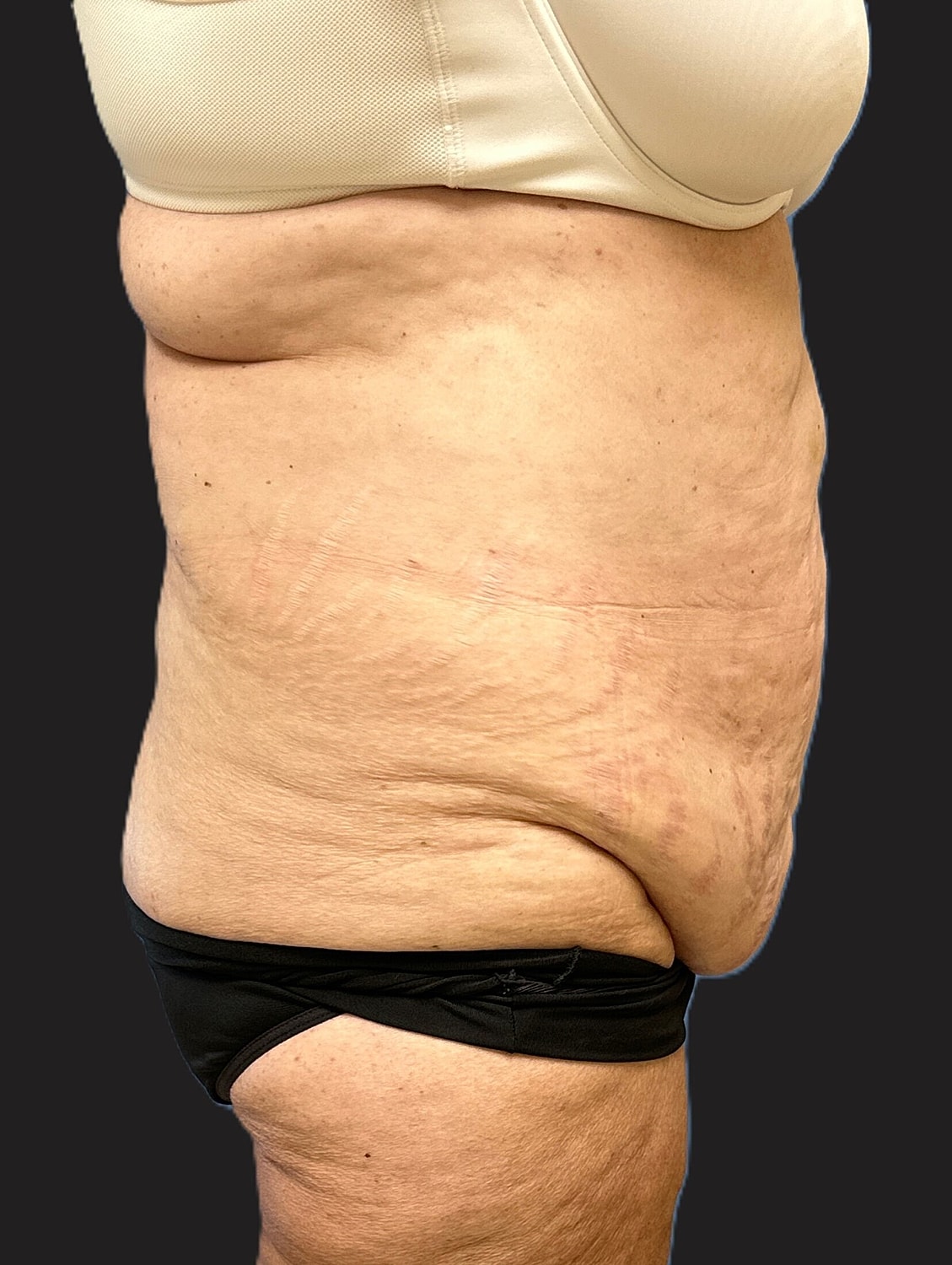 Tummy Tuck Before & After