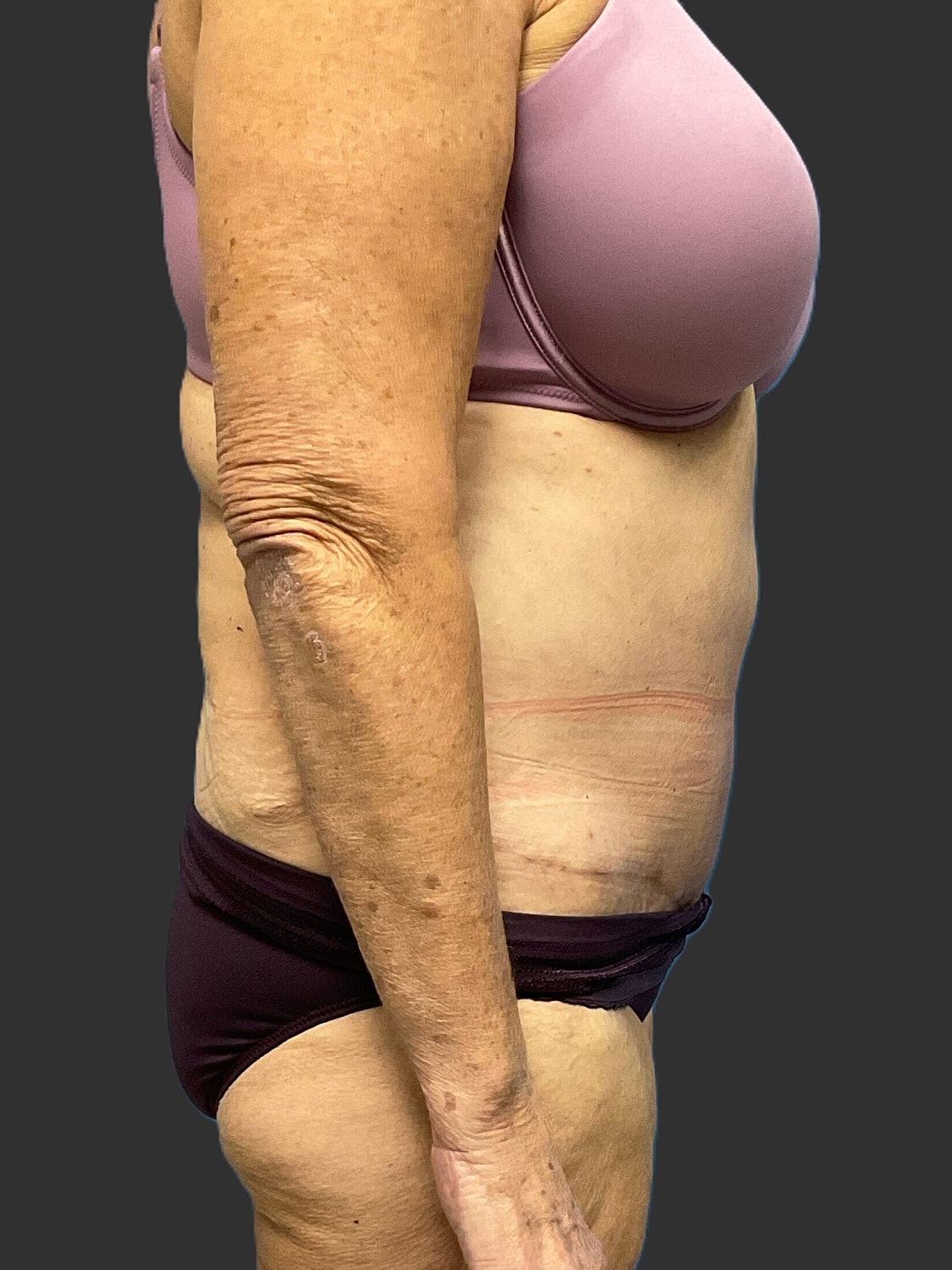 Tummy Tuck Before & After