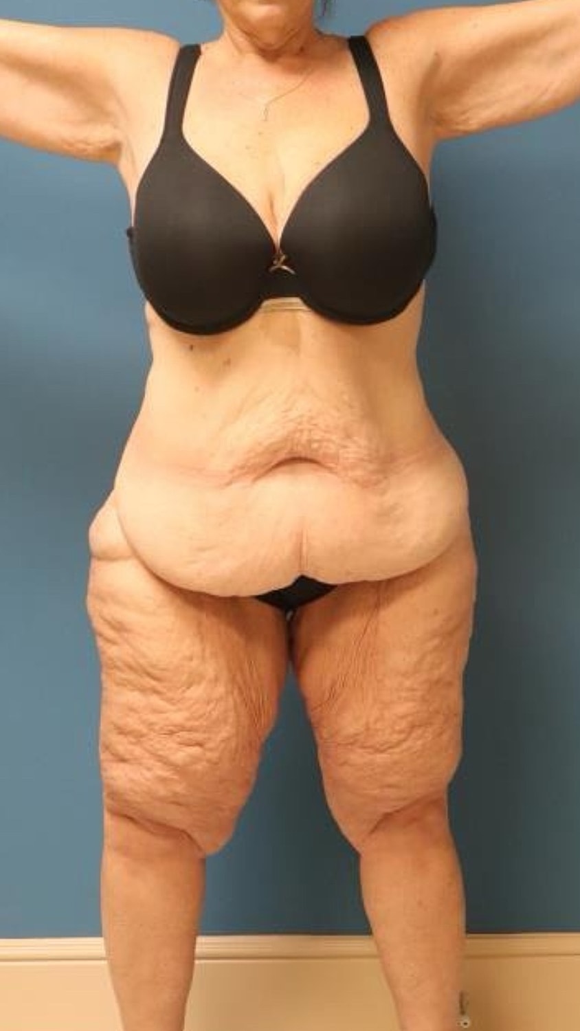 Tummy Tuck Before & After