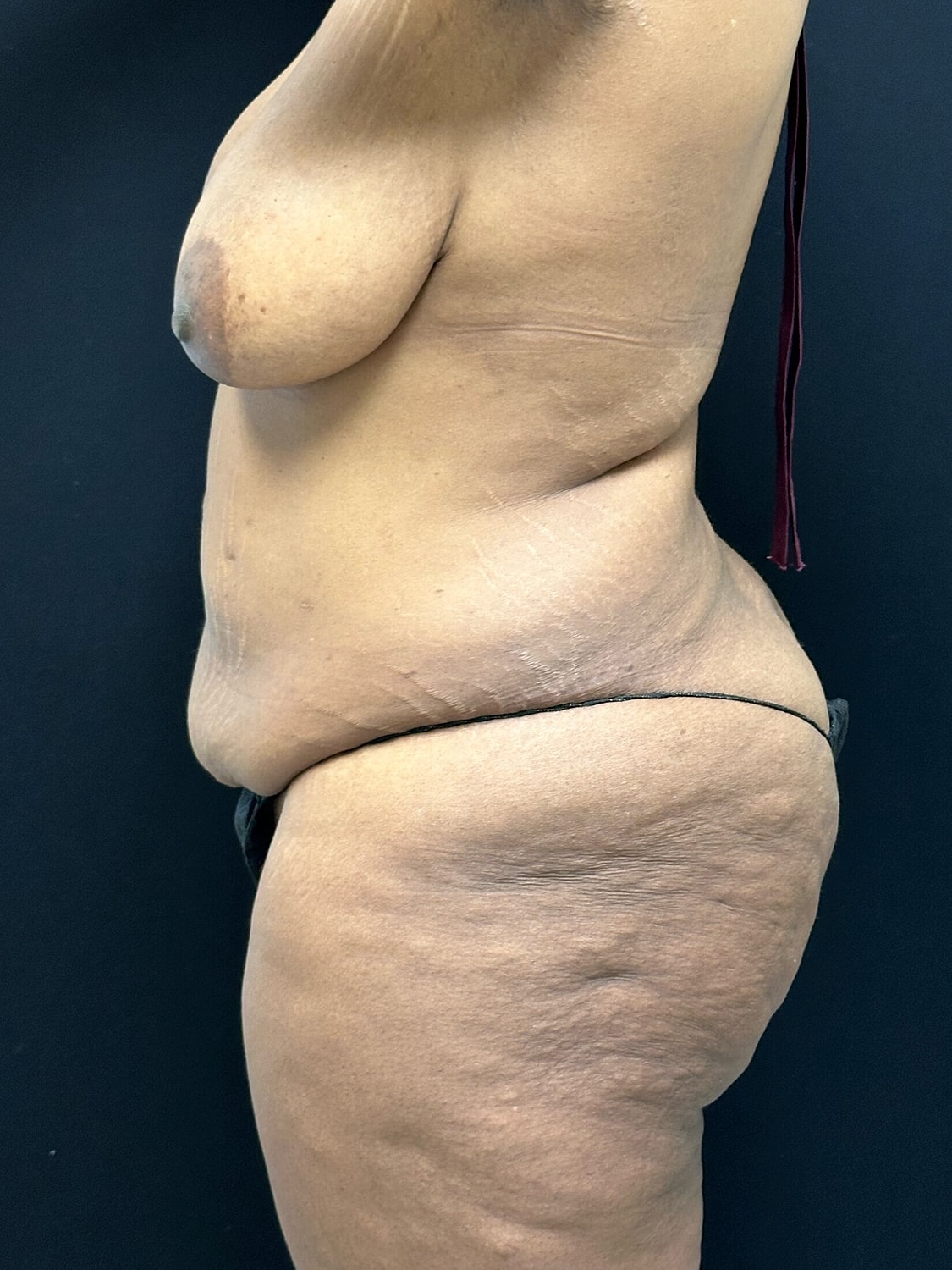 Tummy Tuck Before & After