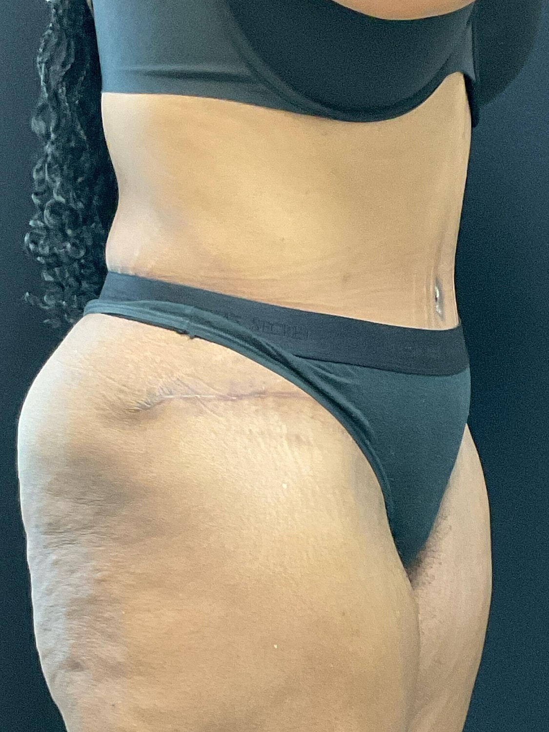 Tummy Tuck Before & After