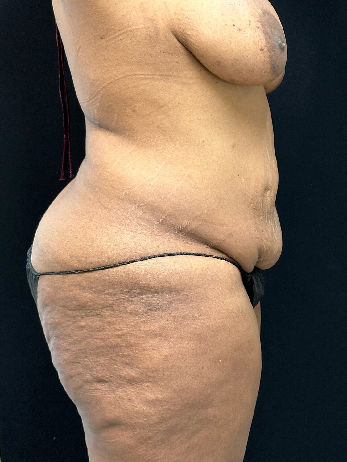 Tummy Tuck Before & After