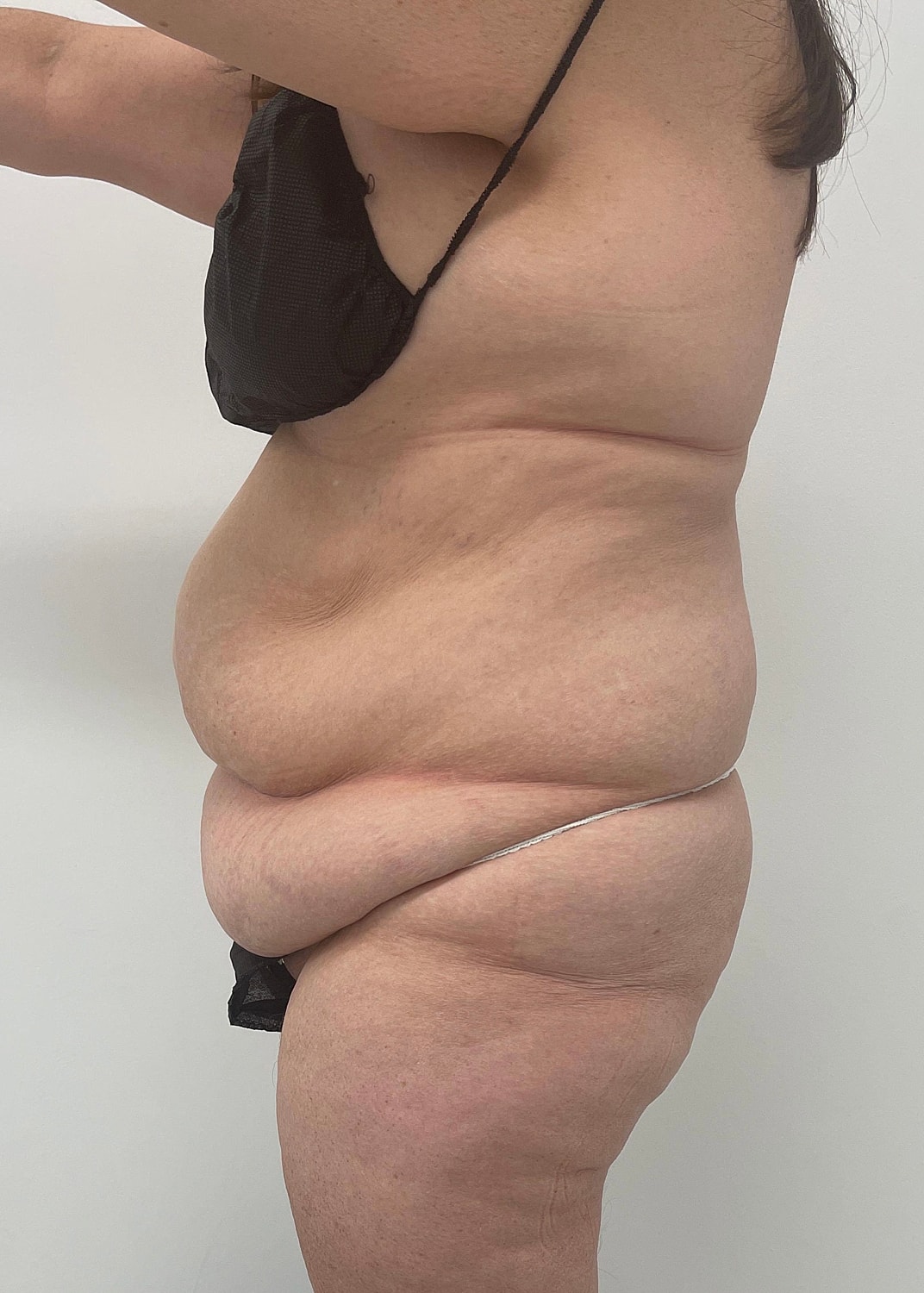 Tummy Tuck Before & After