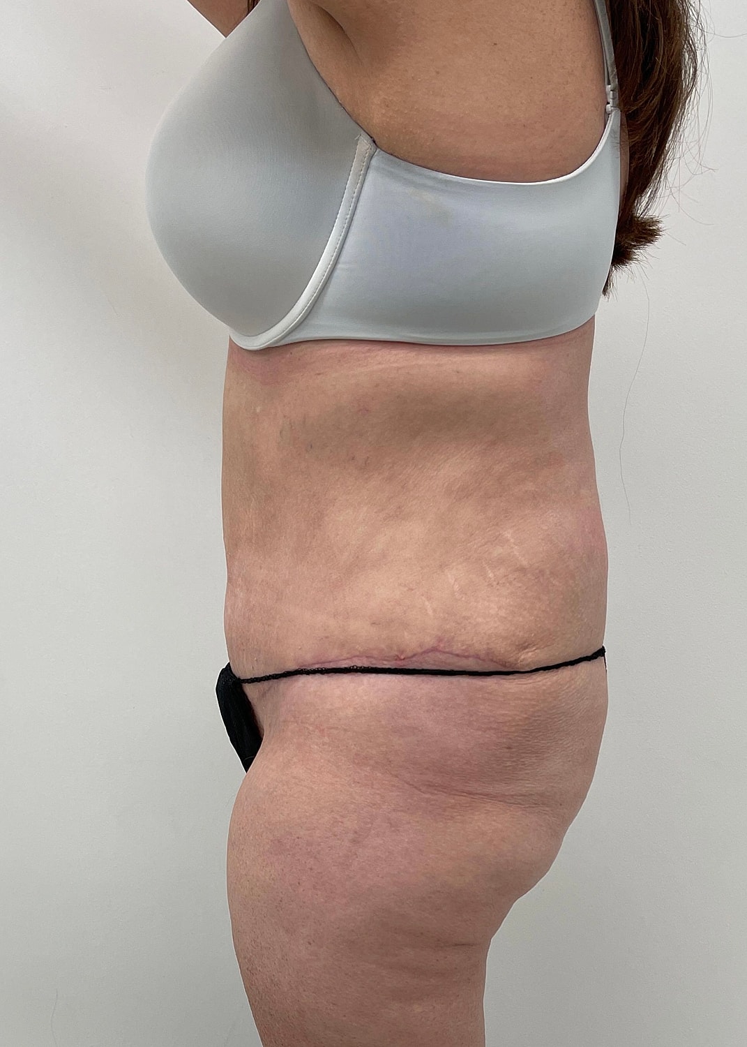 Tummy Tuck Before & After