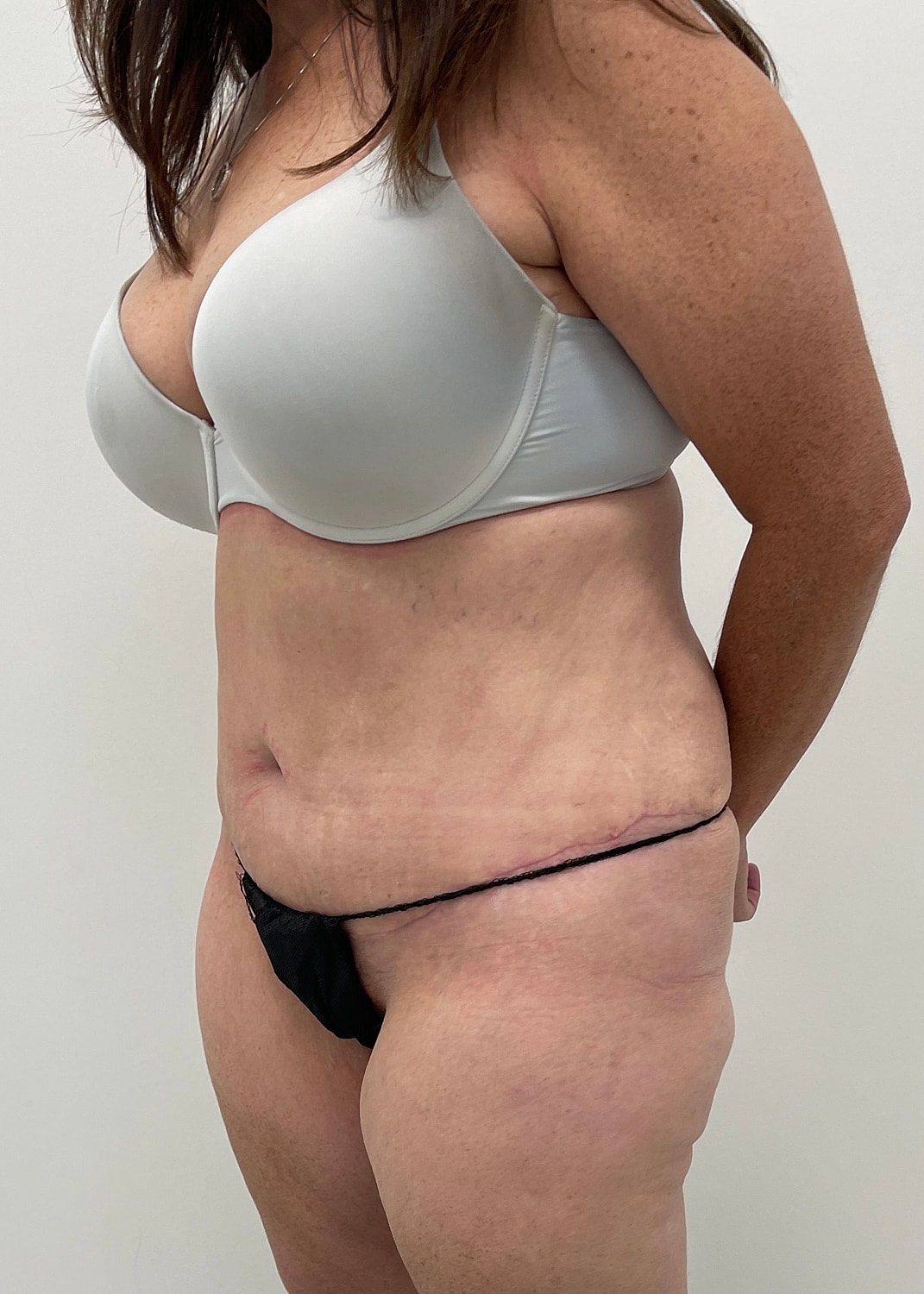 Tummy Tuck Before & After