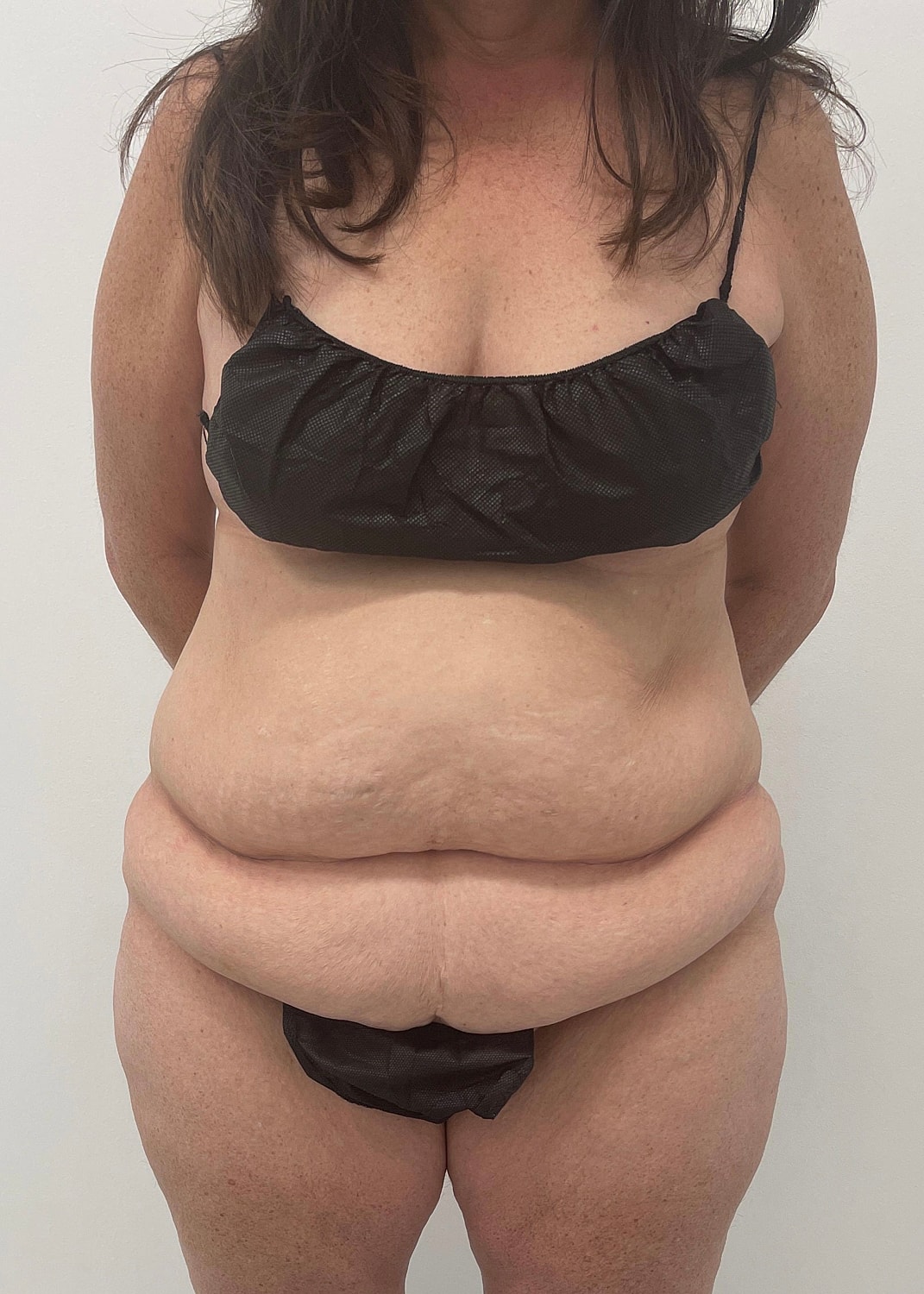 Tummy Tuck Before & After