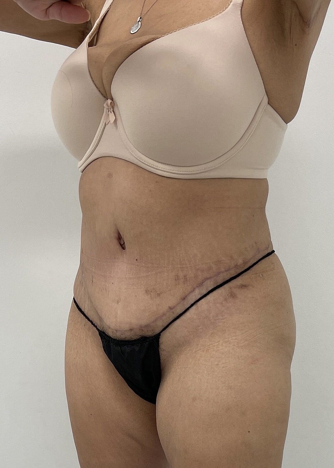 Tummy Tuck Before & After