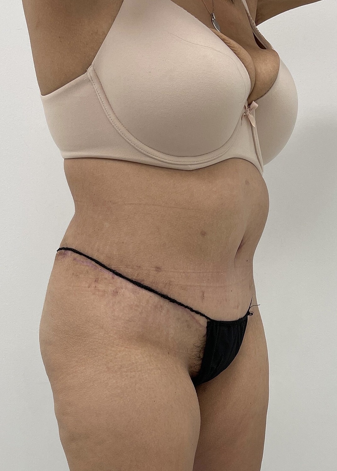Tummy Tuck Before & After