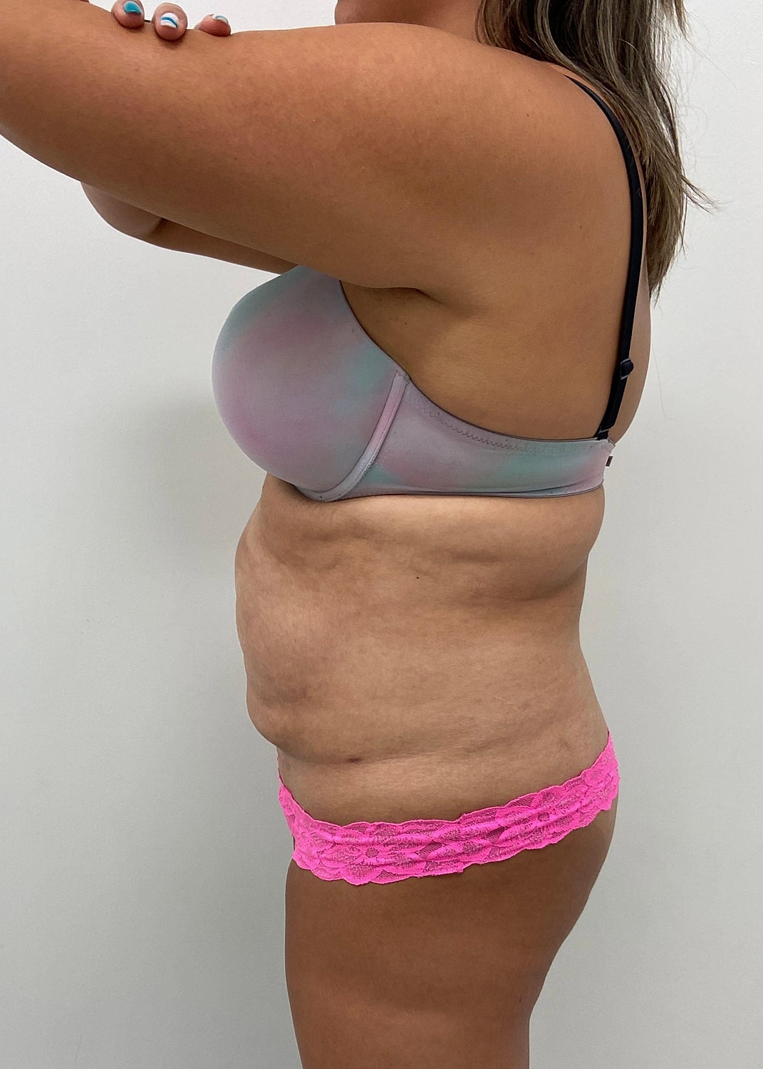 Tummy Tuck Before & After