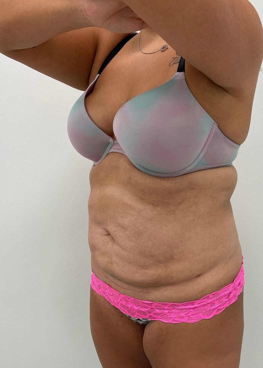 Tummy Tuck Before & After