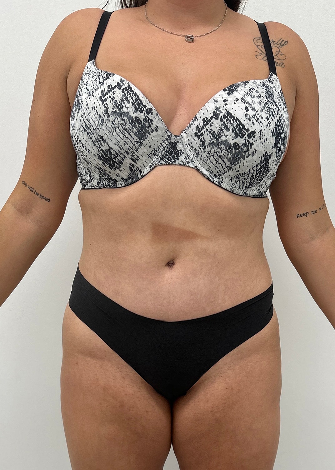 Tummy Tuck Before & After