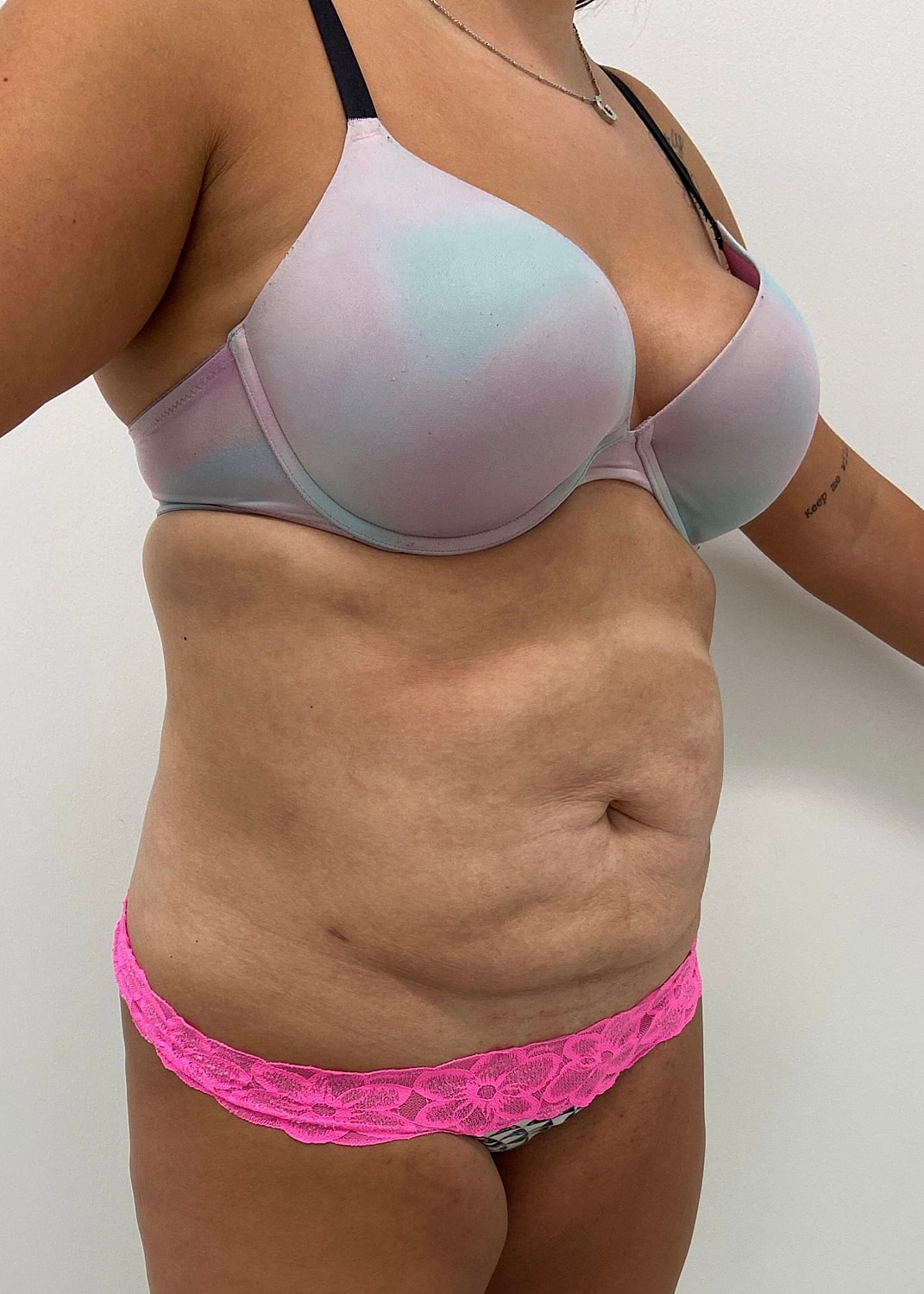 Tummy Tuck Before & After