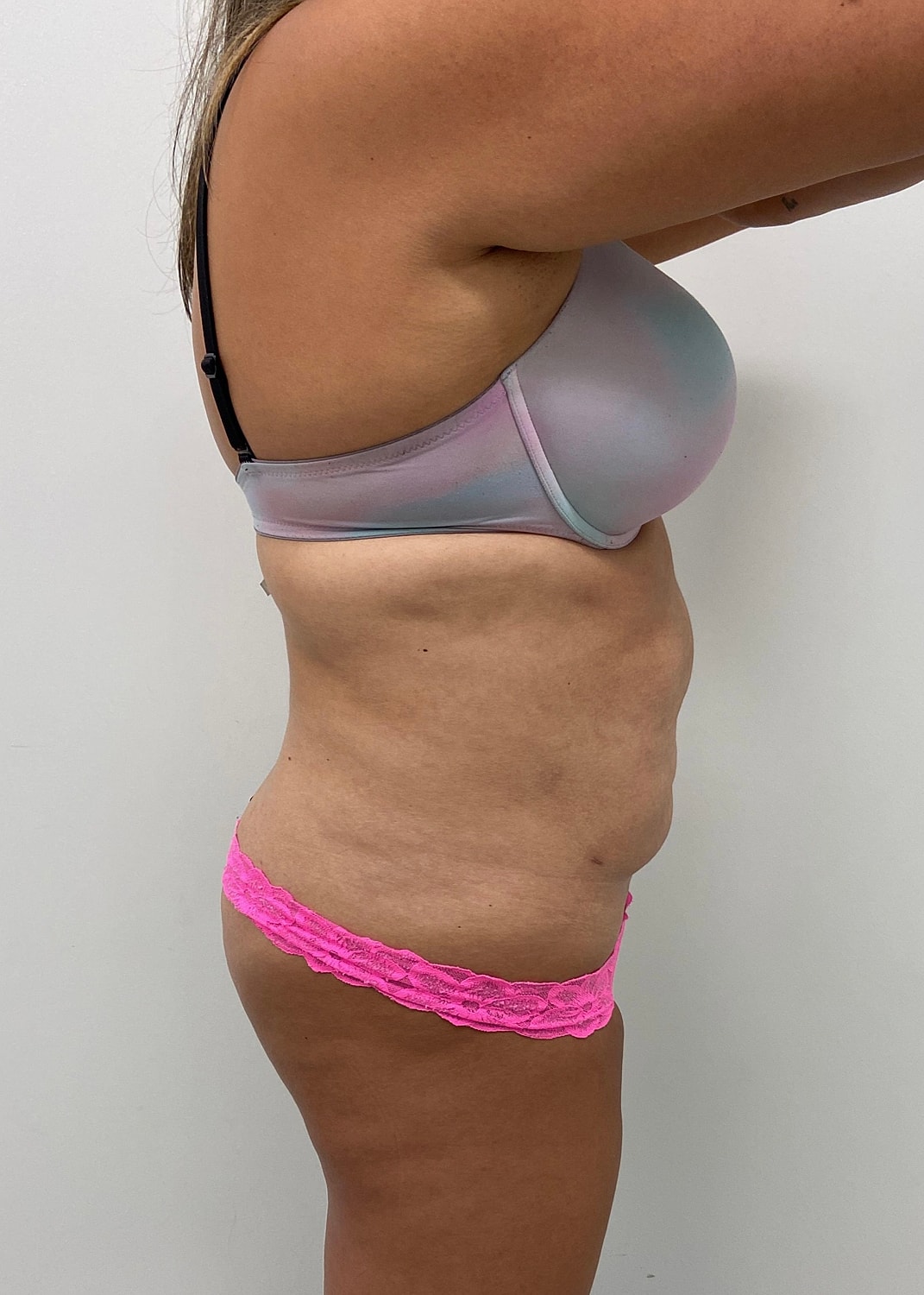 Tummy Tuck Before & After