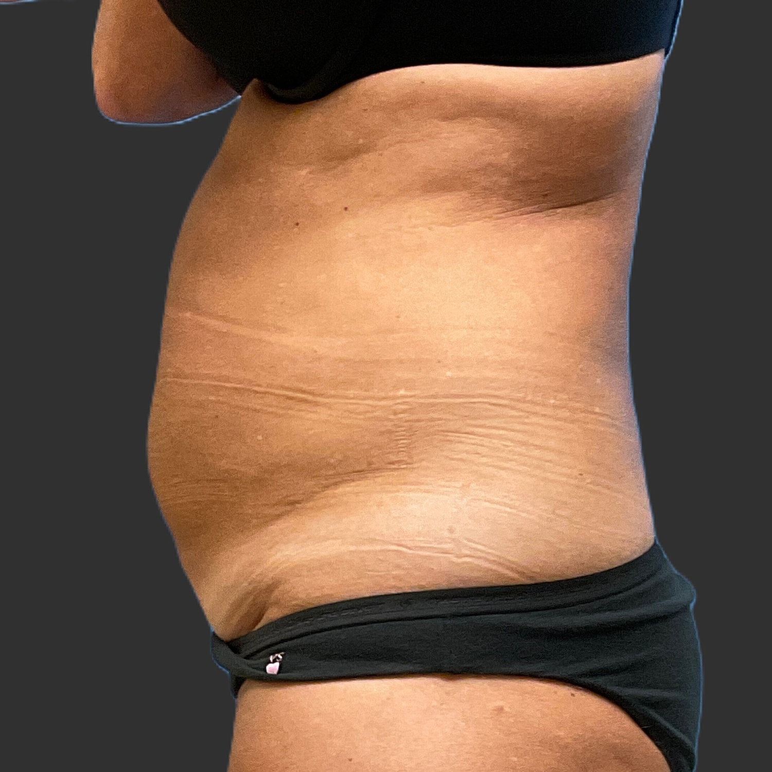Tummy Tuck Before & After