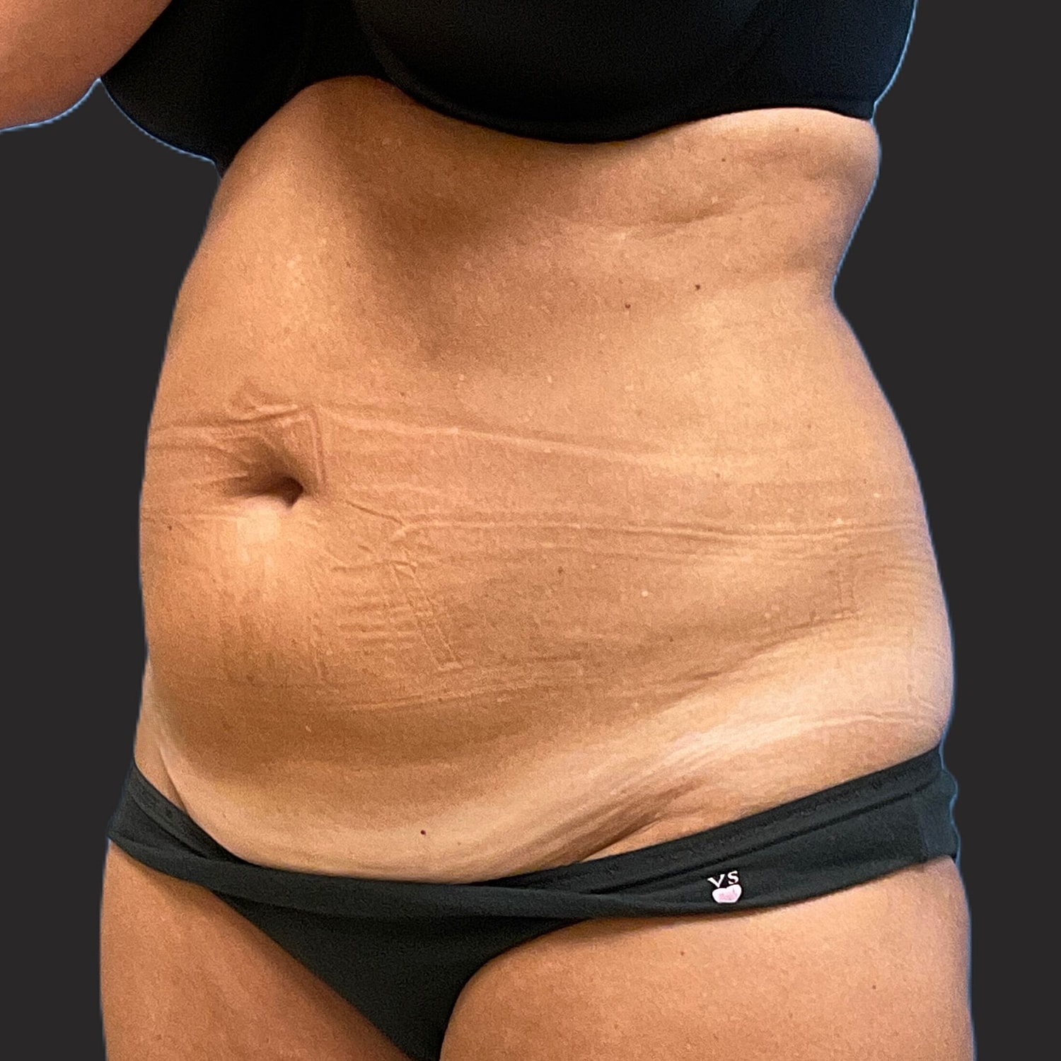 Tummy Tuck Before & After