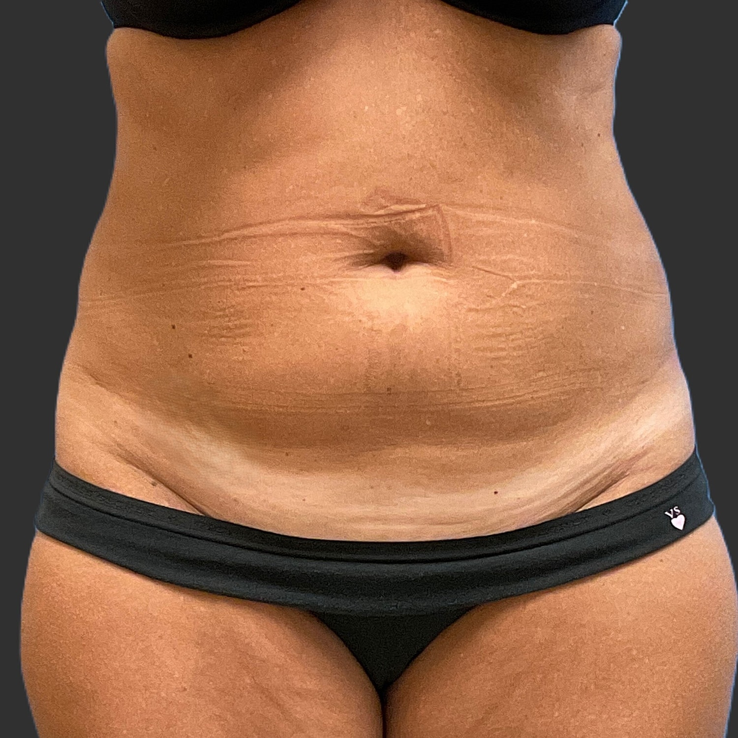 Tummy Tuck Before & After