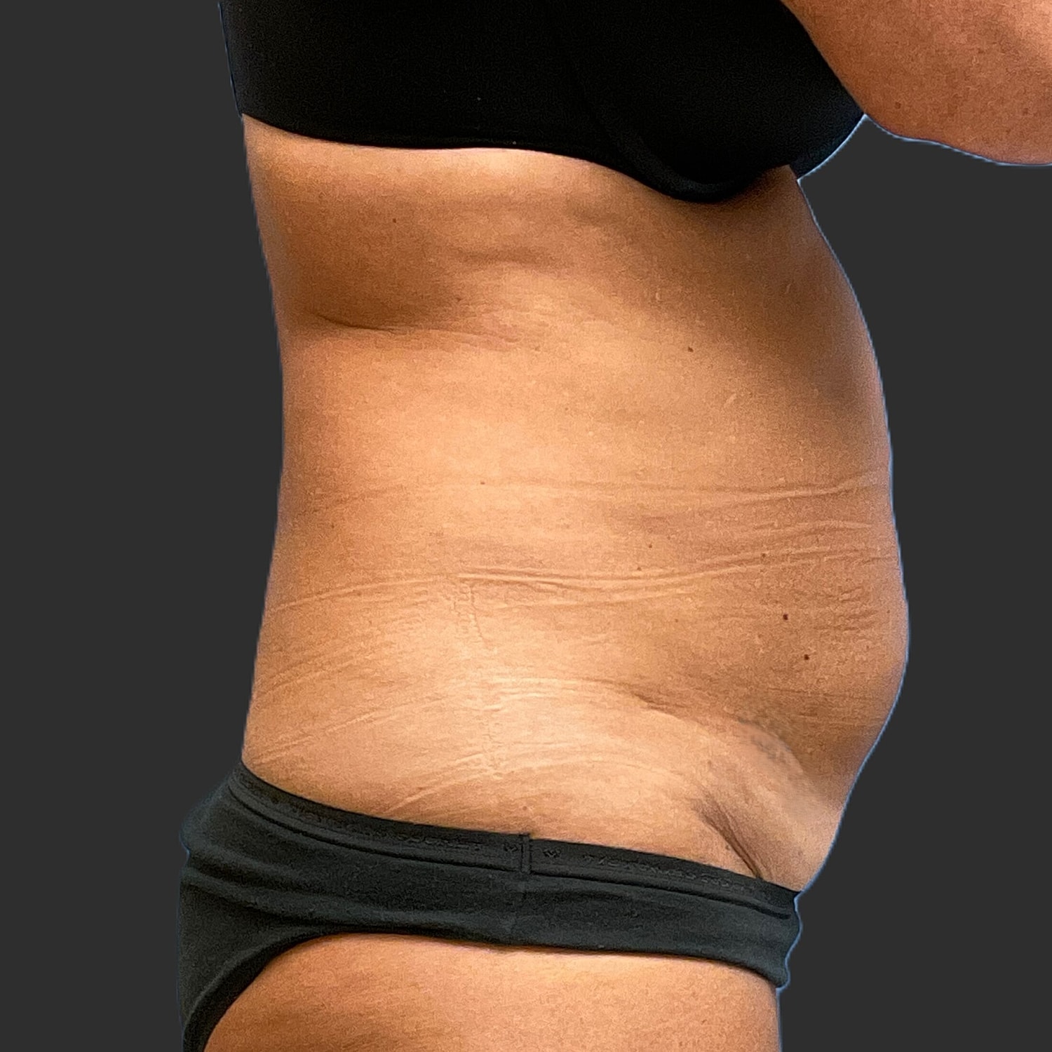 Tummy Tuck Before & After
