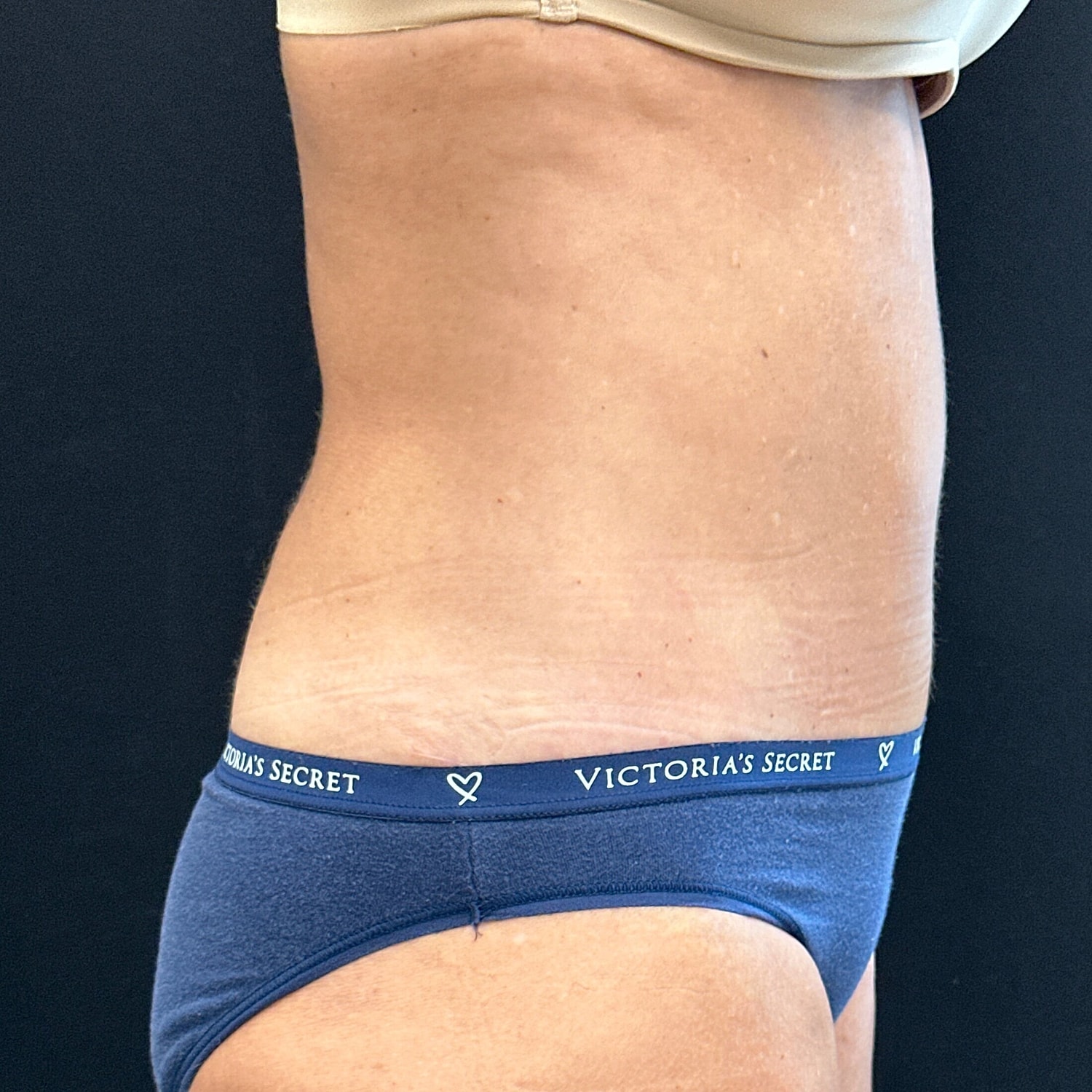 Tummy Tuck Before & After