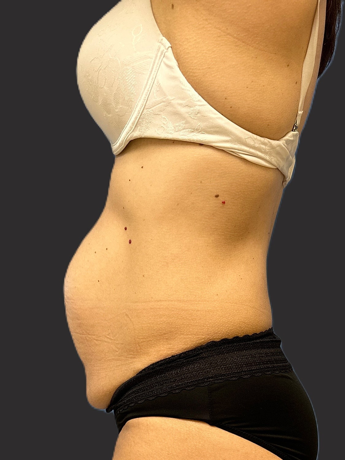Tummy Tuck Before & After